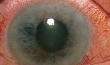 जागतिक काचबिंदू सप्ताहानिमित्त  यशवंतराव चव्हाण ग्रामीण रुग्णालयात आज मोफत काचबिंदू तपासणी शिबिर