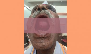 टाळूला वाढलेली मासाची गाठ काढण्यात डॉक्टरांना यश  यशवंतराव चव्हाण ग्रामीण रुग्णालयातील कान-नाक-घसा तज्ज्ञांची कामग‍िरी